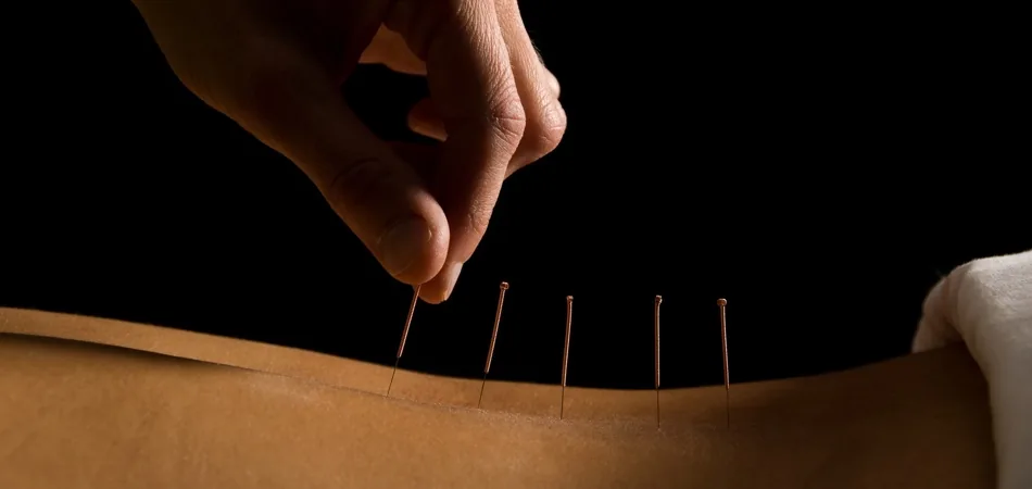 A Acupuntura